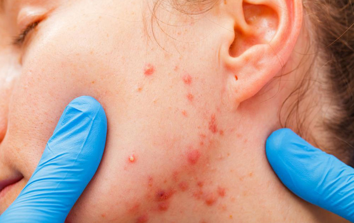 What you need to know about the types and stages of myeloma